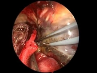 Beyin Tümörü Ameliyatı Riskleri ve Sonrası Beyin Tümörü Ameliyatı Riskleri ve Sonrası