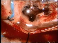 İyi Huylu Tümör Ameliyatı Riskleri ve Sonrası İyi Huylu Tümör Ameliyatı Riskleri ve Sonrası