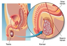 Testis Tümörü Belirtileri ve Tedavisi Testis Tümörü Belirtileri ve Tedavisi