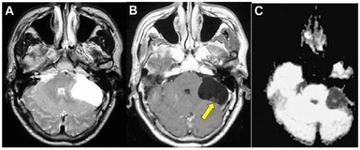 Başta Tümör Belirtileri Nelerdir? Başta Tümör Belirtileri Nelerdir?