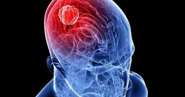 Beyin Tümörü Belirtileri ve Tedavisi Beyin Tümörü Belirtileri ve Tedavisi