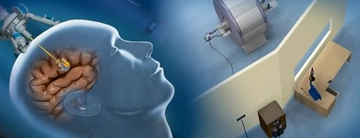 Beyin Tümörü Ameliyatı Riskleri Nelerdir? Beyin Tümörü Ameliyatı Riskleri Nelerdir?