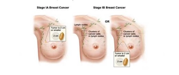 Göğüste Tümör Belirtileri ve Tedavisi Göğüste Tümör Belirtileri ve Tedavisi