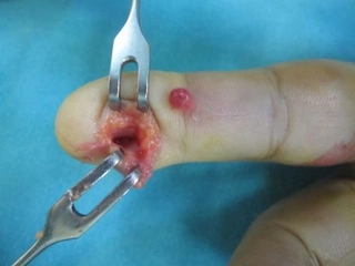 Parmakta Tümör Belirtileri ve Tedavisi Parmakta Tümör Belirtileri ve Tedavisi