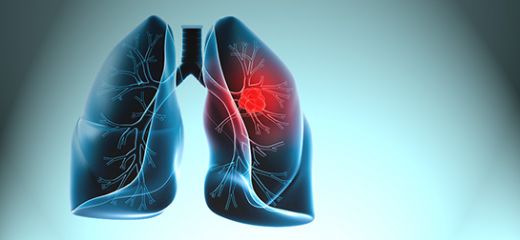 Akciğer Tümörü
