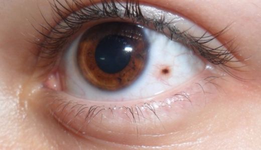 Göz Tümörü Ameliyatı