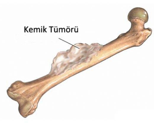 yi Huylu Kemik Tmr