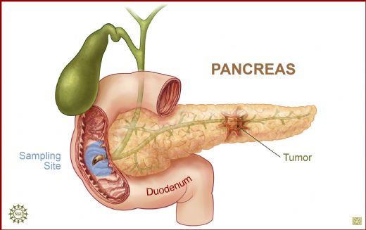 Pankreas Tümörü